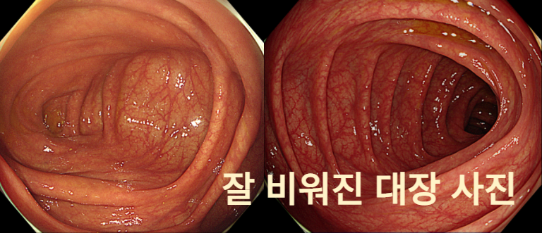 잘 비워진 대장 사진