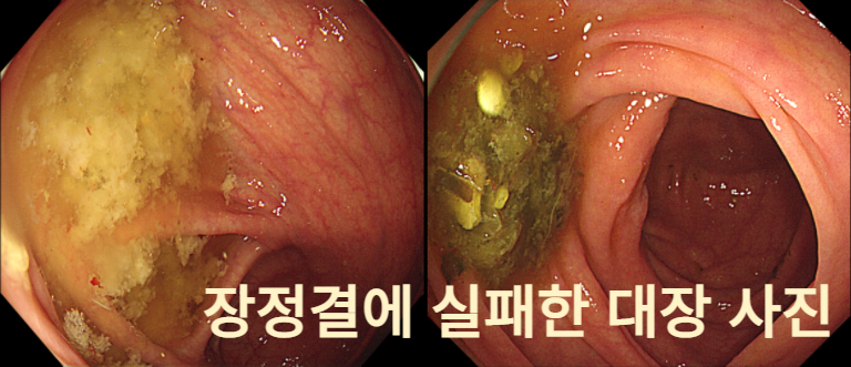 장정결에 실패한 대장 사진