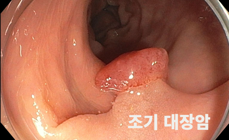 조기 대장암